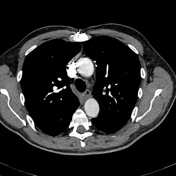 File:Acute pulmonary embolism (Radiopaedia 81677-95570 Axial C+ CTPA 19).jpg
