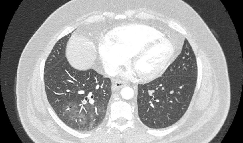 Acute pulmonary embolism with pulmonary infarcts (Radiopaedia 77688-89908 Axial lung window 87).jpg