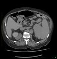 Acute renal failure post IV contrast injection- CT findings (Radiopaedia 47815-52557 Axial non-contrast 29).jpg