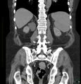 Acute renal failure post IV contrast injection- CT findings (Radiopaedia 47815-52557 Coronal non-contrast 35).jpg