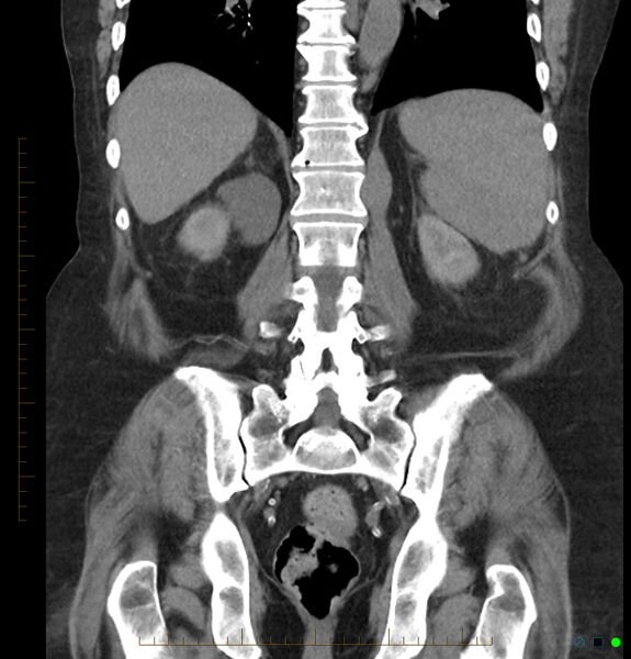 File:Acute renal failure post IV contrast injection- CT findings (Radiopaedia 47815-52557 Coronal non-contrast 35).jpg