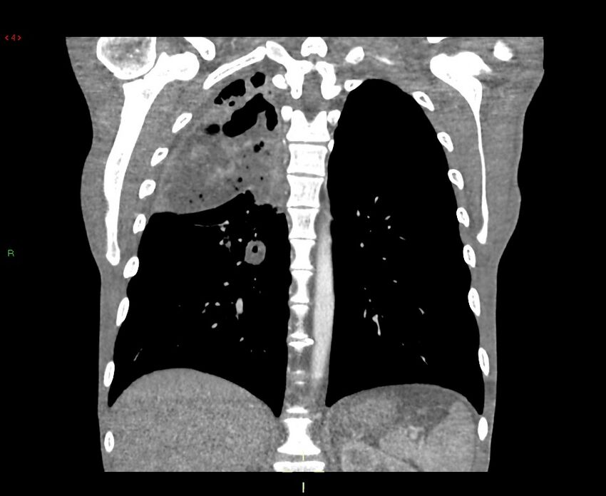 Acute right lung abscess (Radiopaedia 34806-36258 Coronal C+ arterial phase 16).jpg