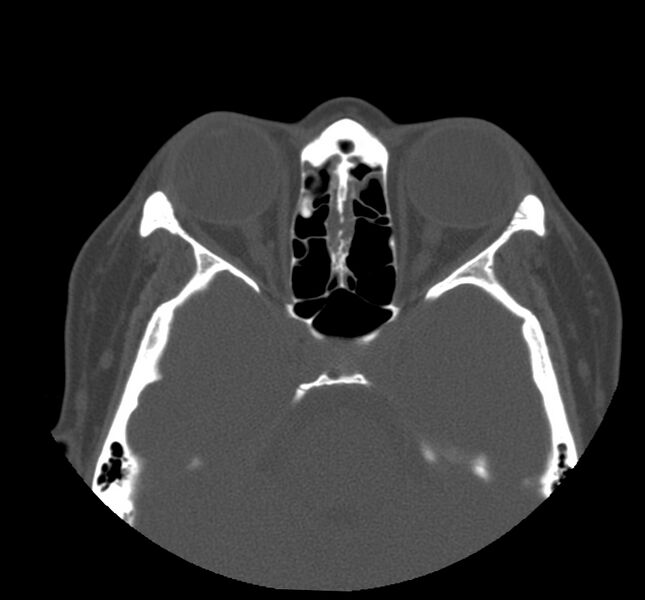 File:Acute sinusitis (Radiopaedia 22419-22455 Axial non-contrast 22).jpg