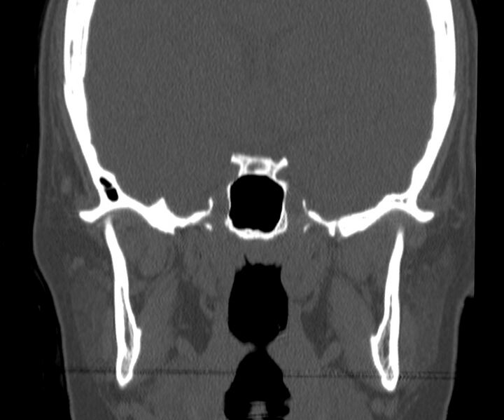 File:Acute sinusitis (Radiopaedia 22419-22455 Coronal bone window 37).jpg