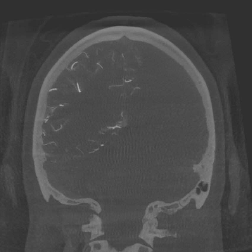 Acute subarachnoid hemorrhage and accessory anterior cerebral artery (Radiopaedia 69231-79010 Coronal arterial - MIP 75).jpg
