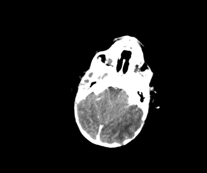 File:Acute ventriculitis (Radiopaedia 57502-64459 Axial +contrast 5).jpg