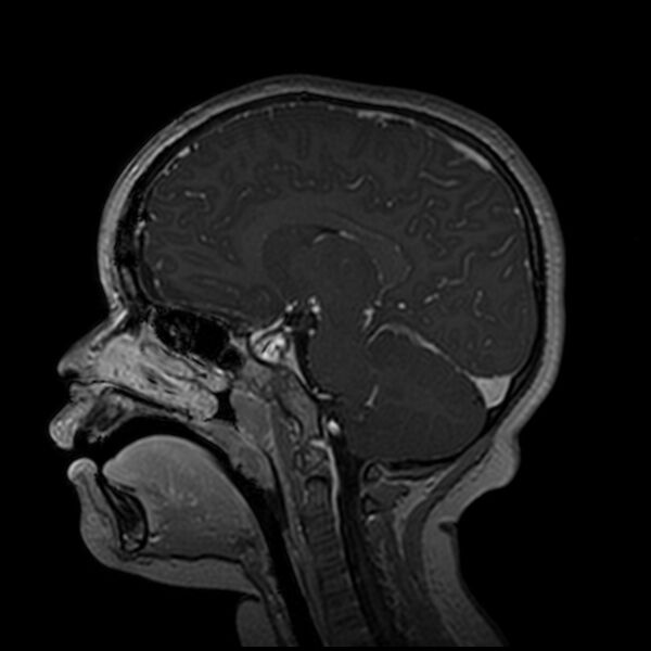 File:Adamantinomatous craniopharyngioma (Radiopaedia 77407-89529 H 68).jpg