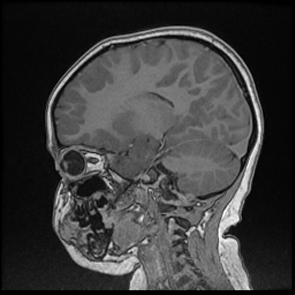 File:Adamantinomatous craniopharyngioma (Radiopaedia 77407-89529 Sagittal T1 C+ 83).jpg