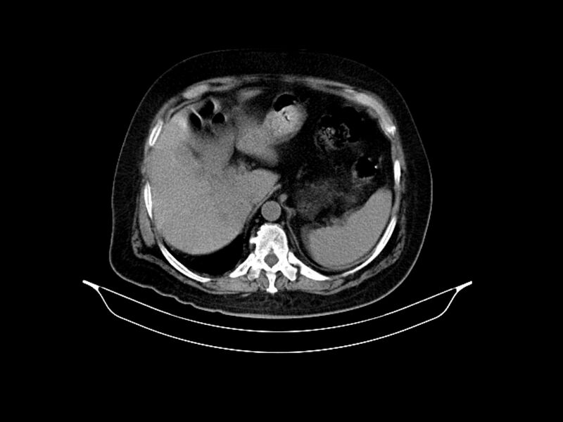 File:Adenocarcinoma of pancreas with hepatic metastasis (Radiopaedia 64332-73122 Axial non-contrast 26).jpg