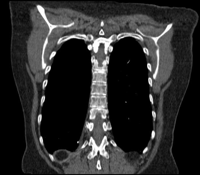 File:Adenocarcinoma of the lung (Radiopaedia 44205-47803 Coronal C+ portal venous phase 81).jpg