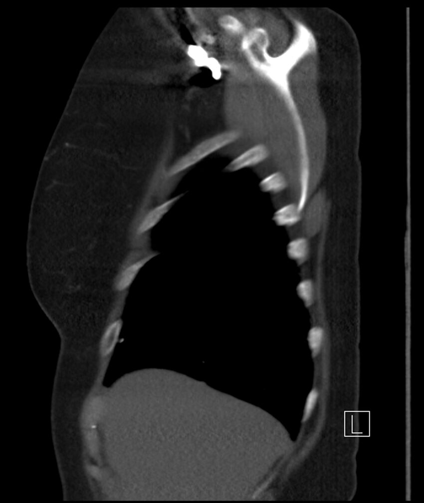 Adenocarcinoma of the lung (Radiopaedia 44205-47803 Sagittal C+ portal venous phase 49).jpg