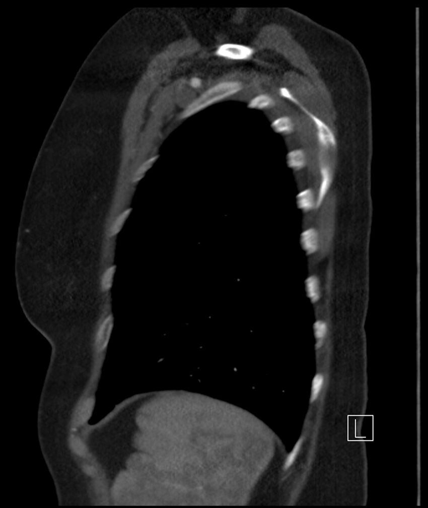 Adenocarcinoma of the lung (Radiopaedia 44205-47803 Sagittal C+ portal venous phase 9).jpg