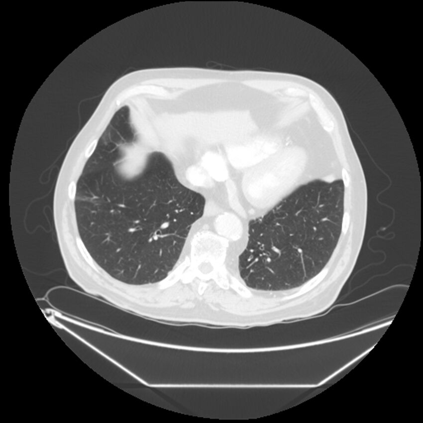 Adenocarcinoma of the lung (Radiopaedia 44876-48759 Axial lung window 61).jpg