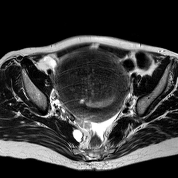 File:Adenomyoma of the uterus (huge) (Radiopaedia 9870-10438 Axial T2 23).jpg