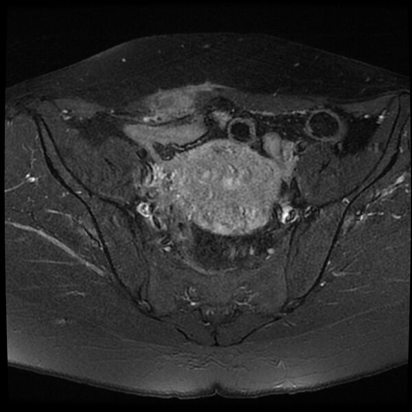 File:Adenomyosis-scar endometriosis (Radiopaedia 65863-75022 Axial T1 C+ fat sat 7).jpg