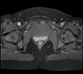 Adenomyosis - ovarian endometriomas (Radiopaedia 67031-76350 Axial T1 C+ fat sat 23).jpg