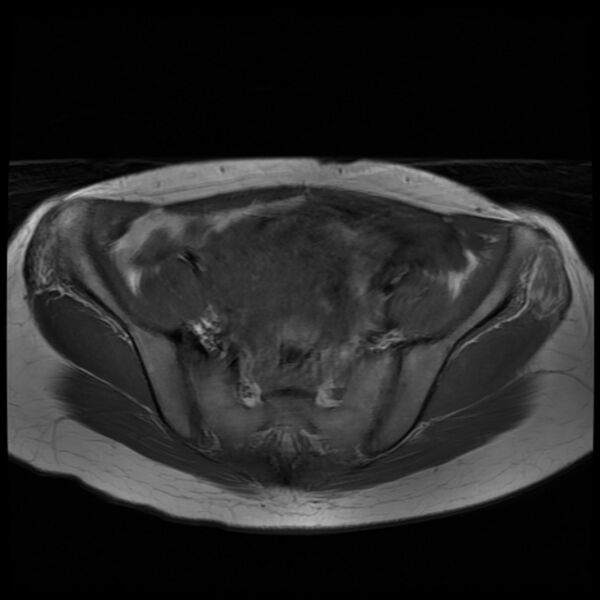File:Adenomyosis on MRI (Radiopaedia 29328-29780 Axial T1 1).jpg