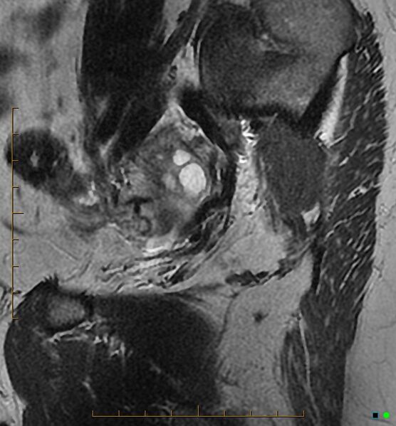 File:Adenomyosis uterus with hematometra (Radiopaedia 45779-50011 Sagittal T2 27).jpg