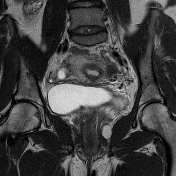 File:Adenomyosis within a septate uterus (Radiopaedia 69963-79981 Coronal T2 16).jpg