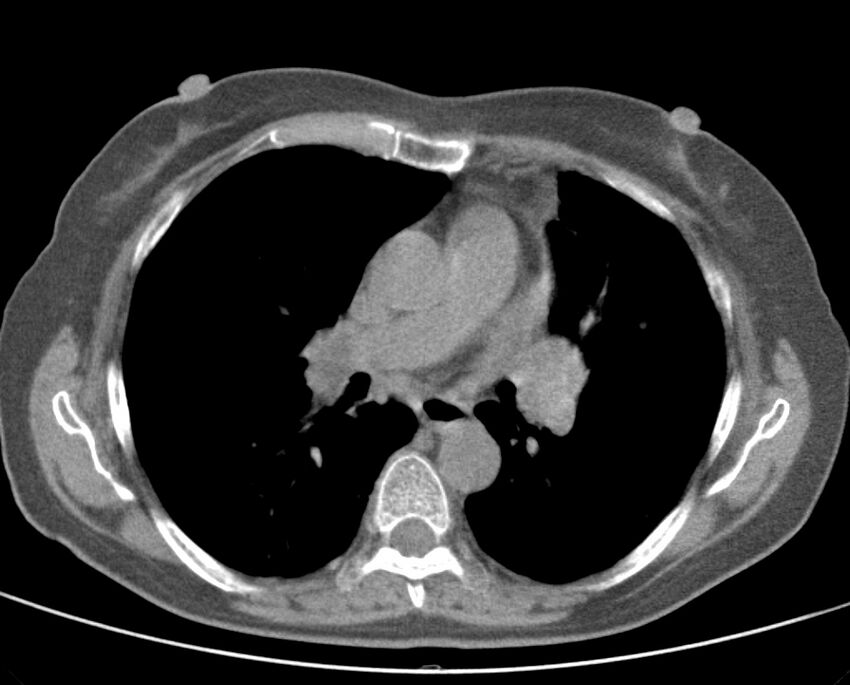 Adenosquamous lung carcinoma (Radiopaedia 22035-22030 non-contrast 31).jpg