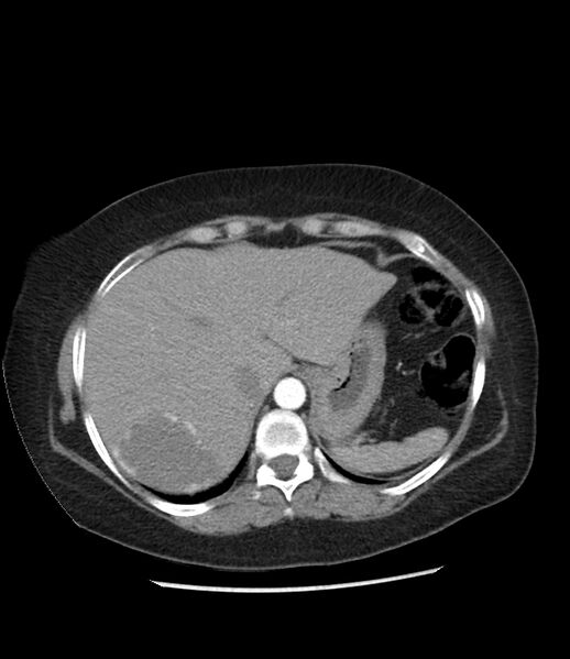 File:Adrenal cortical carcinoma with IVC invasion and thrombosis (Radiopaedia 34307-35597 Axial C+ arterial phase 15).jpg