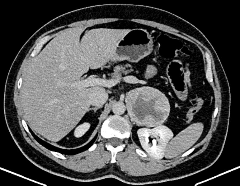File:Adrenal metastases (Radiopaedia 73082-83791 Axial C+ delayed 93).jpg