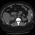Adrenal myelolipoma (Radiopaedia 8216-9068 Axial non-contrast 23).jpg