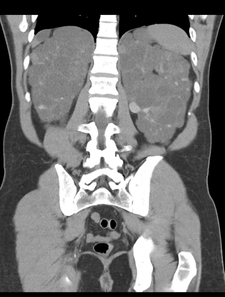 File:Adult polycystic kidney disease (Radiopaedia 47866-52626 Coronal non-contrast 37).png