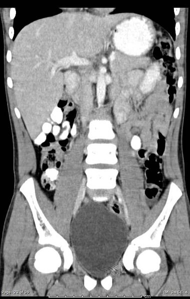 File:Agenesis of the gallbladder (Radiopaedia 55454-61905 Coronal 6).jpg