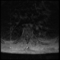 Aggressive vertebral hemangioma (Radiopaedia 39937-42404 Axial T1 C+ fat sat 20).png