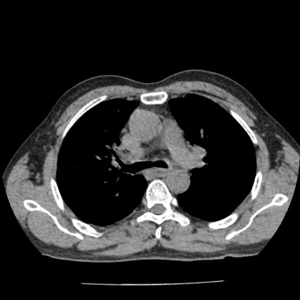 File:Airway foreign body in adult (Radiopaedia 85907-101779 Axial liver window 58).jpg