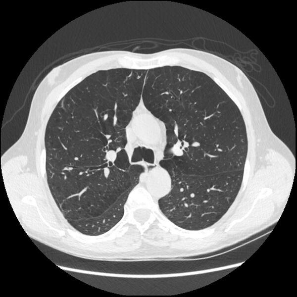 File:Alpha-1-antitrypsin deficiency (Radiopaedia 40993-43722 Axial lung window 85).jpg