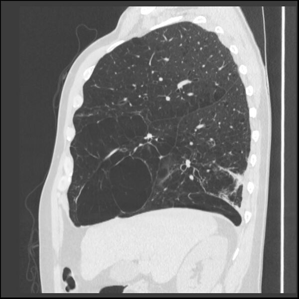 File:Alpha-1-antitrypsin deficiency (Radiopaedia 40993-43722 Sagittal lung window 191).jpg