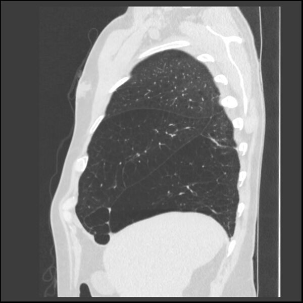 File:Alpha-1-antitrypsin deficiency (Radiopaedia 40993-43722 Sagittal lung window 225).jpg