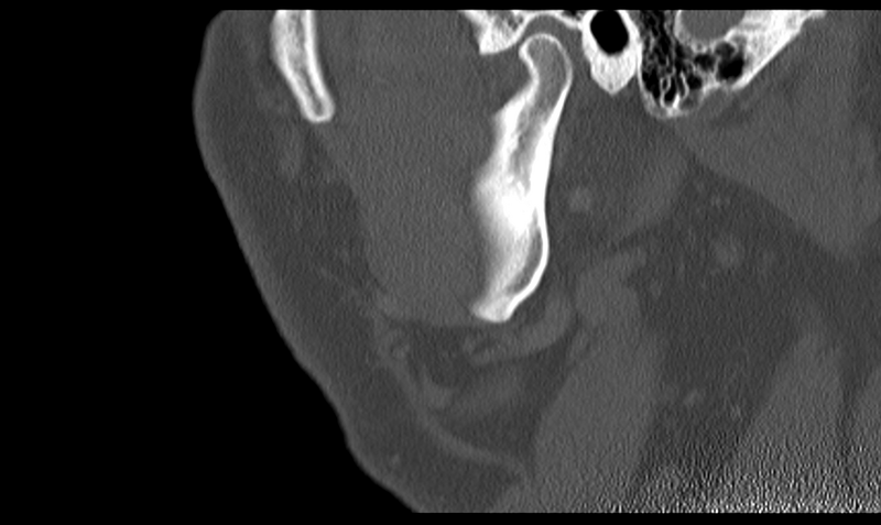 File:Ameloblastoma (Radiopaedia 33677-34806 Sagittal bone window 50).png