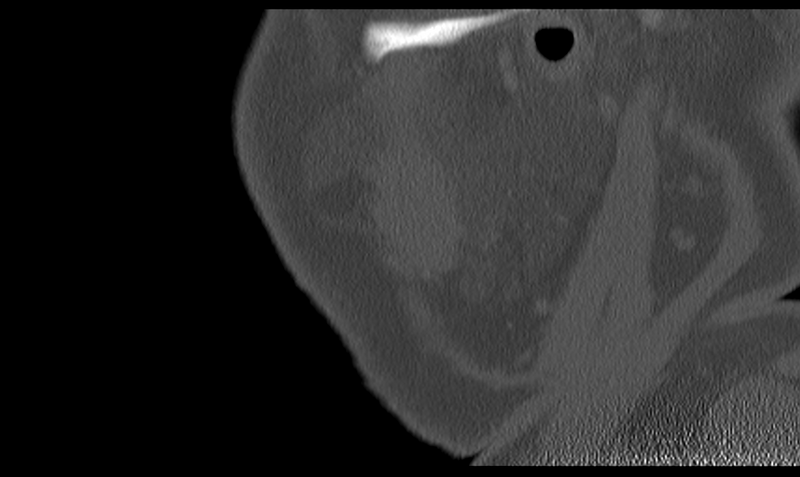 File:Ameloblastoma (Radiopaedia 33677-34806 Sagittal bone window 55).png