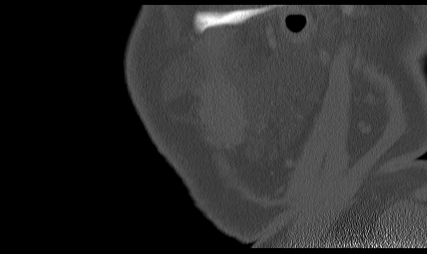 Ameloblastoma (Radiopaedia 33677-34806 Sagittal bone window 55).png