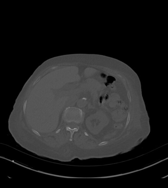 File:Amiodarone deposition in the liver (Radiopaedia 77587-89780 Axial bone window 88).jpg