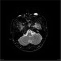 Amnestic syndrome secondary to hypoxic brain injury (Radiopaedia 24743-25004 DWI 39).jpg