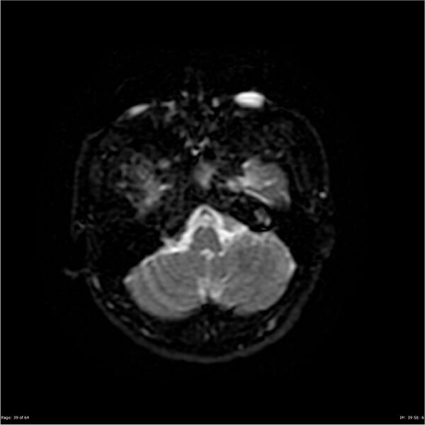 File:Amnestic syndrome secondary to hypoxic brain injury (Radiopaedia 24743-25004 DWI 39).jpg