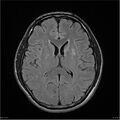Amnestic syndrome secondary to hypoxic brain injury (Radiopaedia 24743-25004 FLAIR 12).jpg