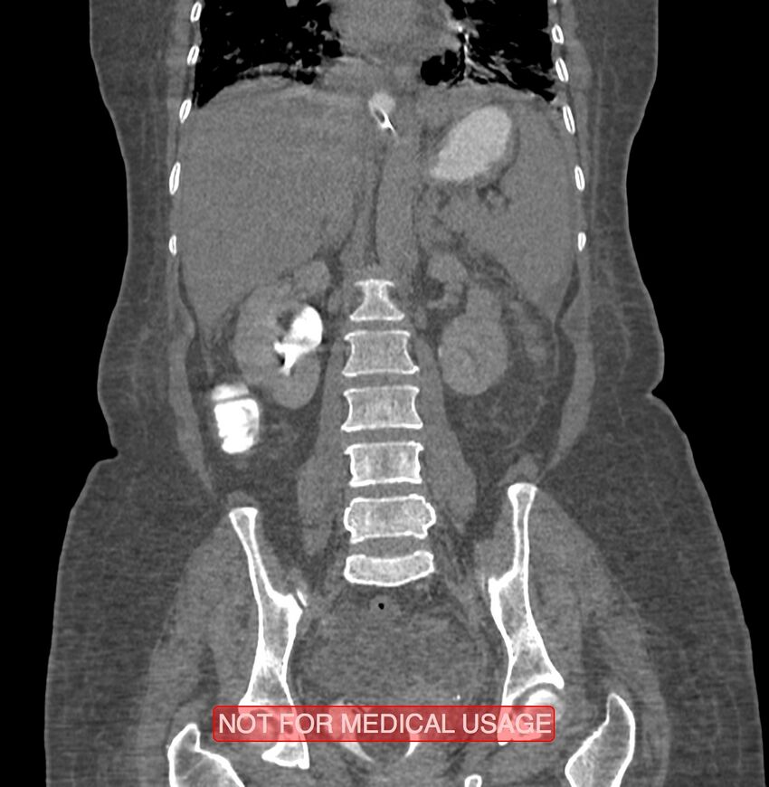 Amoebic enterocolitis with liver abscess (Radiopaedia 35100-36609 B 126).jpg