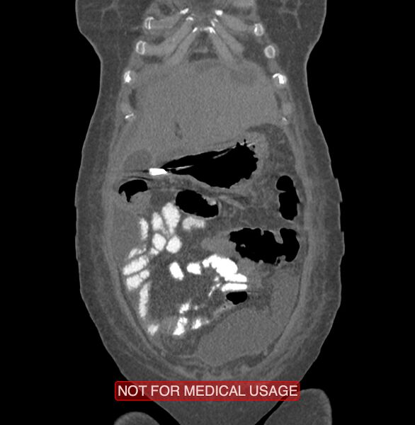 File:Amoebic enterocolitis with liver abscess (Radiopaedia 35100-36609 B 20).jpg
