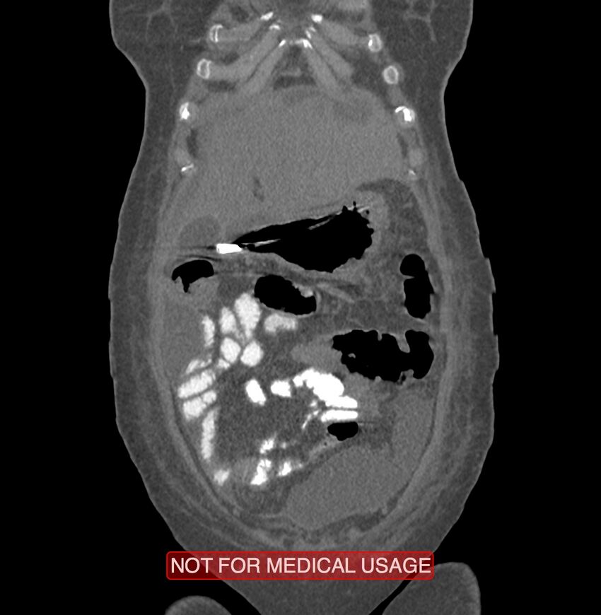 Amoebic enterocolitis with liver abscess (Radiopaedia 35100-36609 B 20).jpg