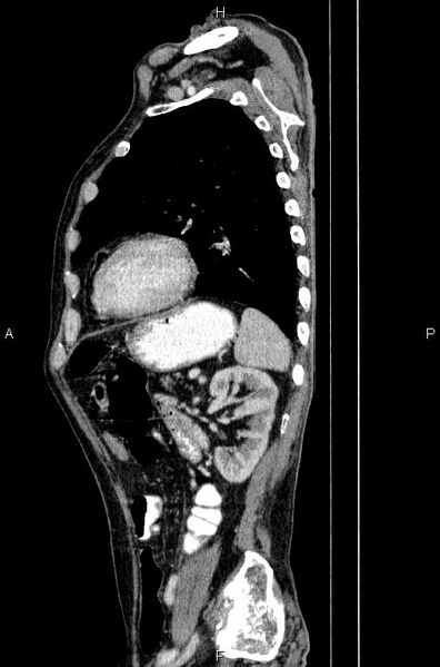 File:Ampullary adenocarcinoma (Radiopaedia 86093-102033 E 68).jpg