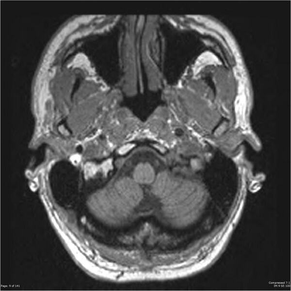 File:Anaplastic meningioma with recurrence (Radiopaedia 34452-35788 Axial T1 7).jpg