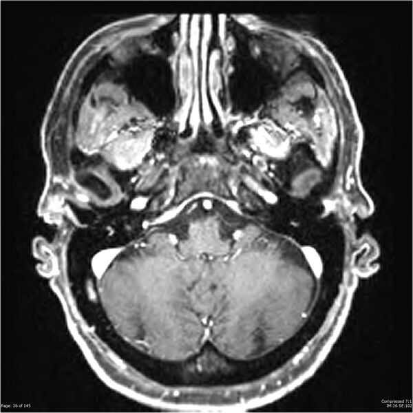File:Anaplastic meningioma with recurrence (Radiopaedia 34452-35788 Axial T1 C+ 26).jpg