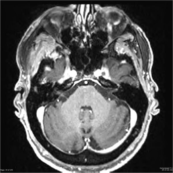 File:Anaplastic meningioma with recurrence (Radiopaedia 34452-35788 Axial T1 C+ 34).jpg