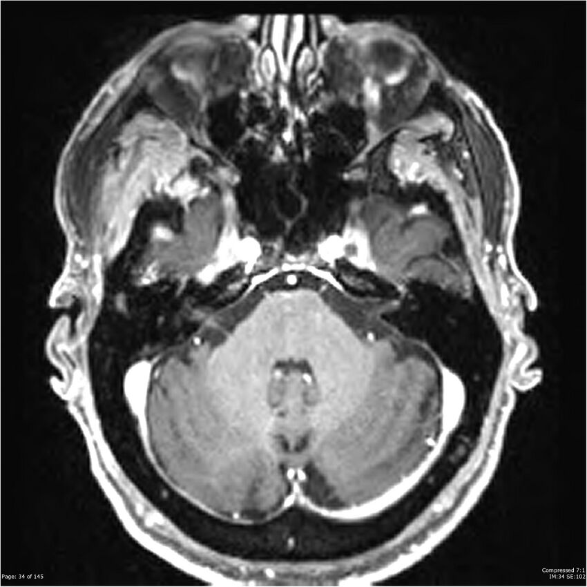 Anaplastic meningioma with recurrence (Radiopaedia 34452-35788 Axial T1 C+ 34).jpg