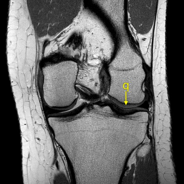 File:Anatomy Quiz (MRI knee) (Radiopaedia 43478-46874 A 19).jpeg